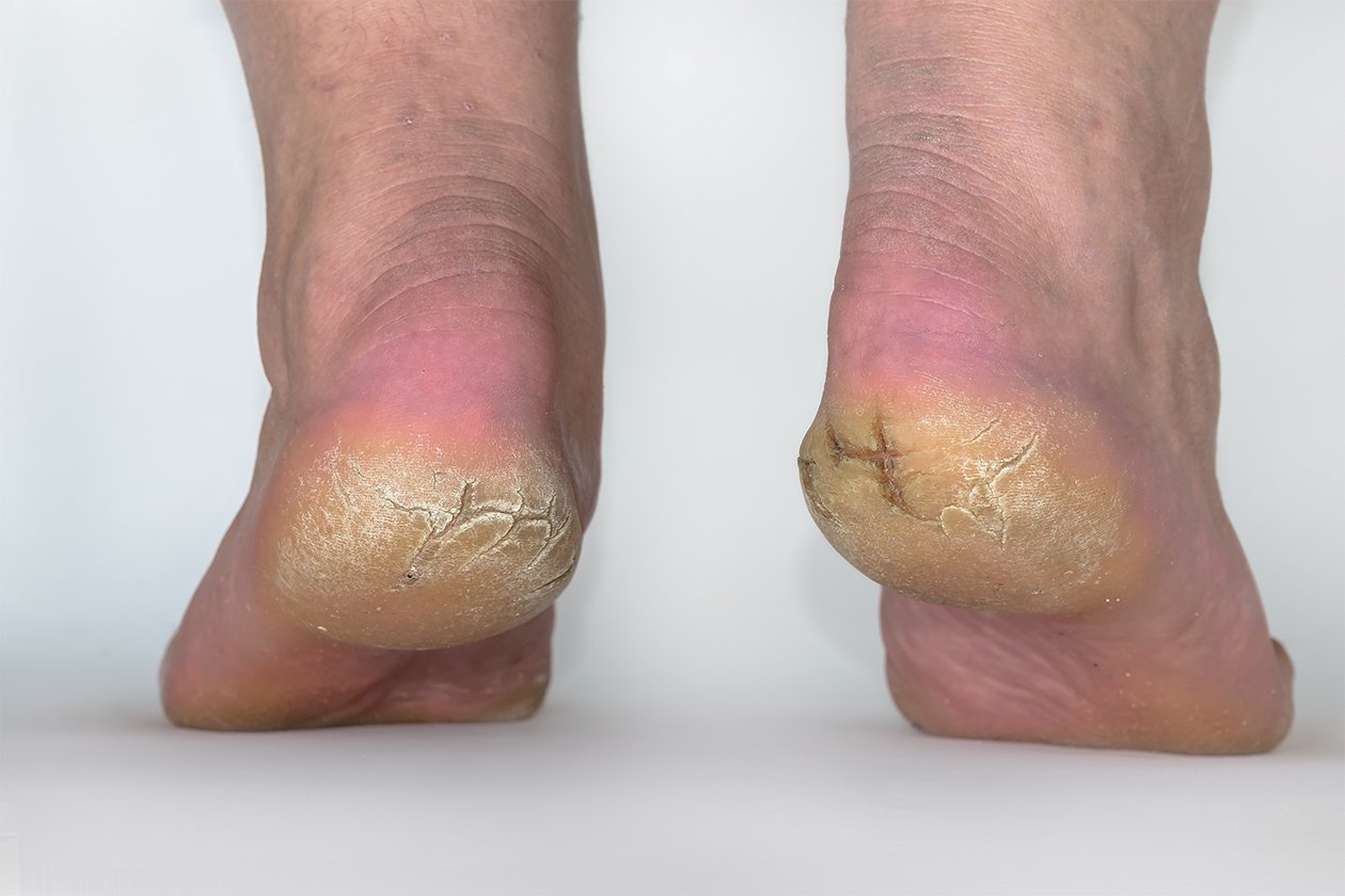 How to get rid of dry, cracked heels - Quora
