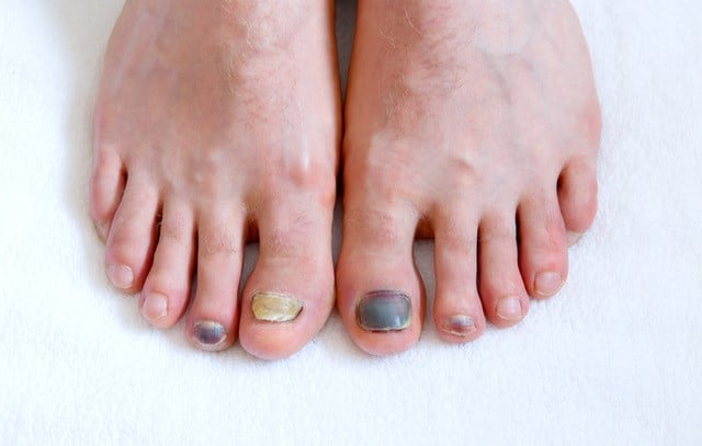 Ingrown Toe Nails - Health Beat